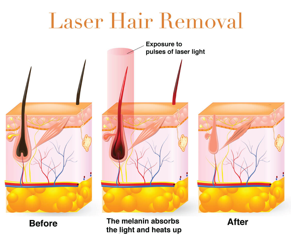 Infographic on laser hair removal