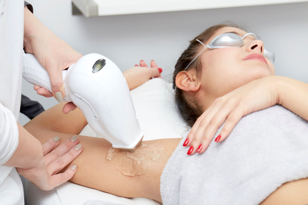 Laser hair removal on underarm